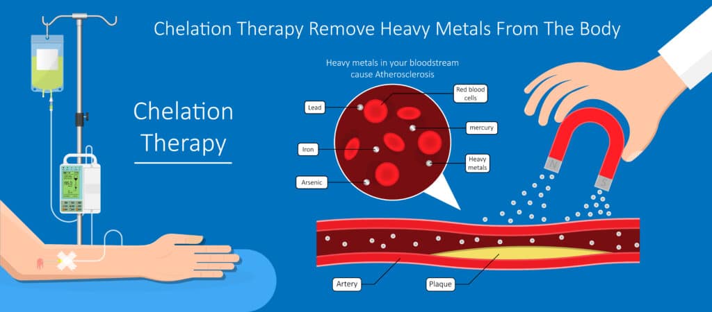 Chelation Therapy for Removing Heavy Metals in Body