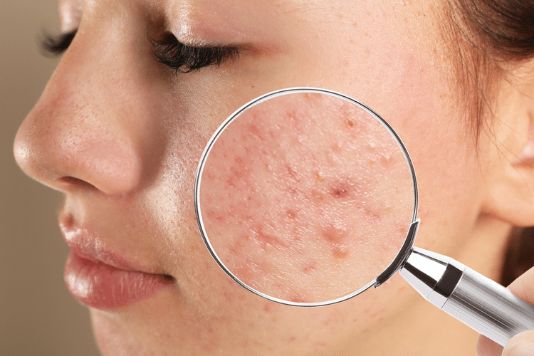 How Does It Impact Acne and Eczema?